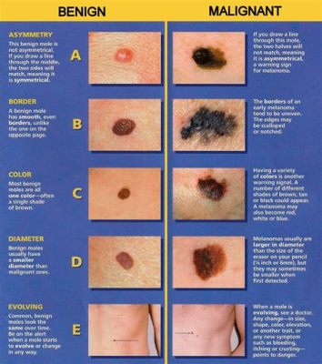 Would Melanoma Show Up in Blood Work: A Journey Through the Labyrinth of Medical Mysteries